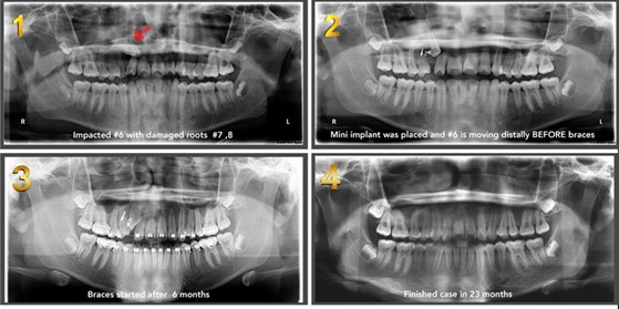 retract impacted canine with TADs mini implants 1